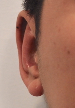 Otoplasty Before & After Patient #2296