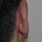 Otoplasty Before & After Patient #2296