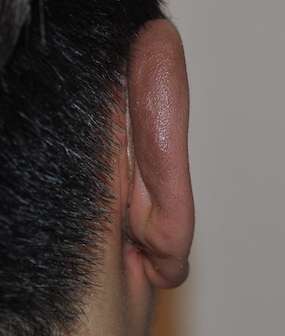 Otoplasty Before & After Patient #2296