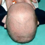 Pediatric Treatments Before & After Patient #2791