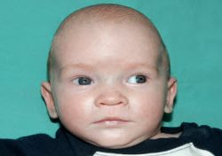 Pediatric Treatments Before & After Patient #2791