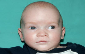 Pediatric Treatments Before & After Patient #2791