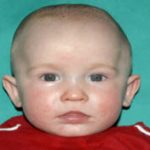 Pediatric Treatments Before & After Patient #2791