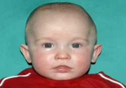 Pediatric Treatments Before & After Patient #2791