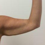 After Weight Loss Before & After Patient #2428