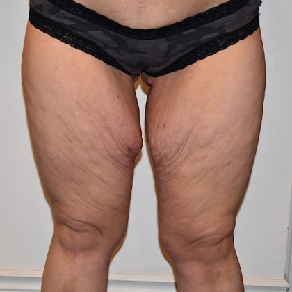 Thigh Lift Before & After Patient #2448
