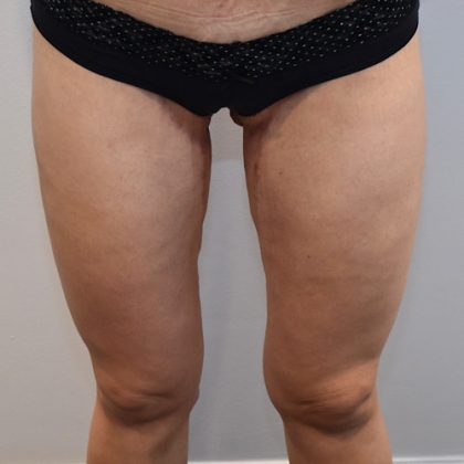 Thigh Lift Before & After Patient #2448