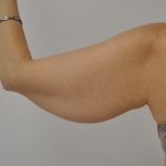 Arm Lift Before & After Patient #2592