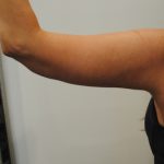 Arm Lift Before & After Patient #2592