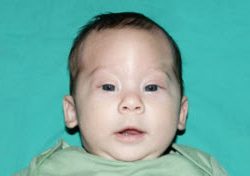 Pediatric Treatments Before & After Patient #2792