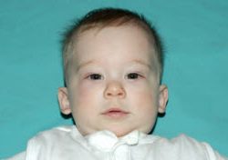 Pediatric Treatments Before & After Patient #2792