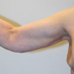 Arm Lift Before & After Patient #2593
