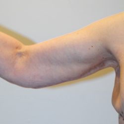 Arm Lift Before & After Patient #2593