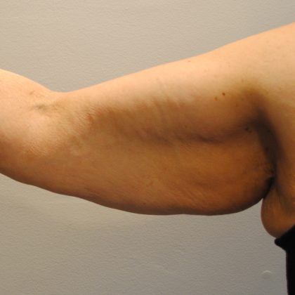 Arm Lift Montreal, Quebec Gaby Doumit