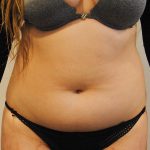 Liposuction Before & After Patient #2501