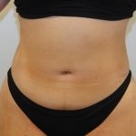 Liposuction Before & After Patient #2501