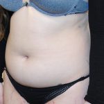 Liposuction Before & After Patient #2501