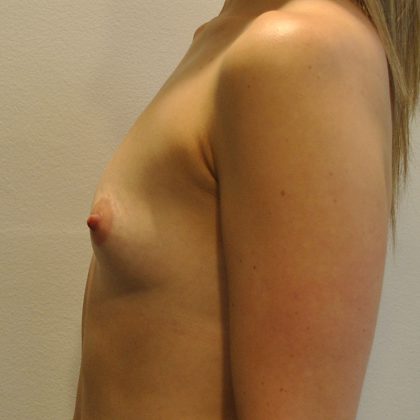 Breast Augmentation Before & After Patient #2464