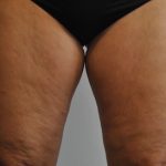 Liposuction Before & After Patient #2503