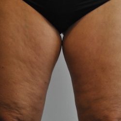 Liposuction Before & After Patient #2503