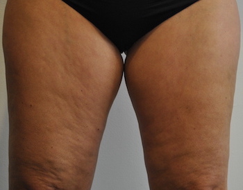 Liposuction Before & After Patient #2503
