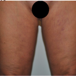 Liposuction Before & After Patient #2503