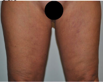 Liposuction Before & After Patient #2503