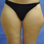Liposuction Before & After Patient #2504