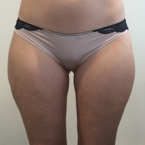 Liposuction Before & After Patient #2504