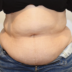 Tummy Tuck Before & After Patient #2451