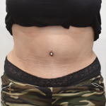 Tummy Tuck Before & After Patient #2451