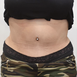 Tummy Tuck Before & After Patient #2451