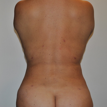 Liposuction Before & After Patient #2506