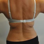 Liposuction Before & After Patient #2506