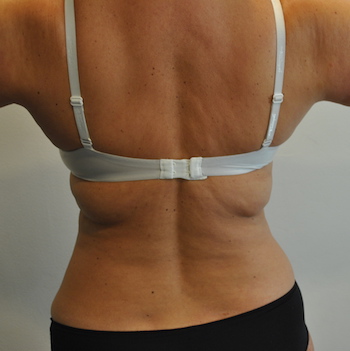 Liposuction Before & After Patient #2506