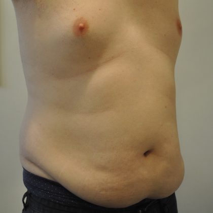 Liposuction Before & After Patient #2508