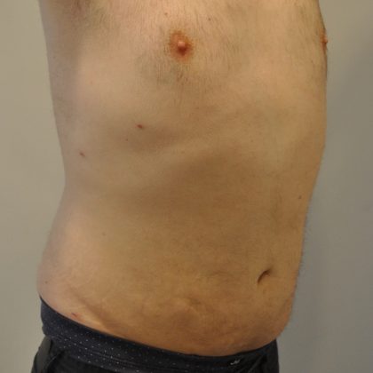 Liposuction Before & After Patient #2508