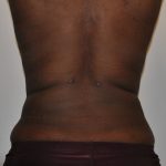 Liposuction Before & After Patient #2510