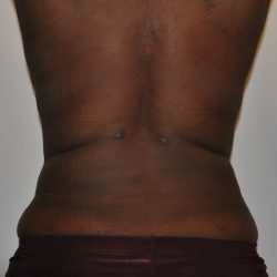 Liposuction Before & After Patient #2510