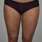 Liposuction Before & After Patient #2551