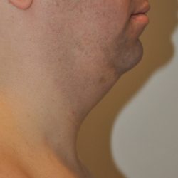 Liposuction Before & After Patient #2552