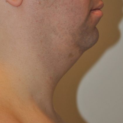 Liposuction Before & After Patient #2552