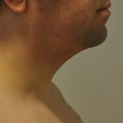Liposuction Before & After Patient #2552