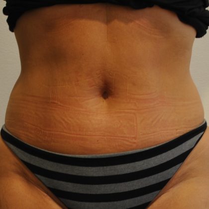 Liposuction Before & After Patient #2562