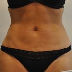 Liposuction Before & After Patient #2562