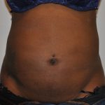 Liposuction Before & After Patient #2560