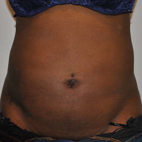 Liposuction Before & After Patient #2560