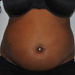 Liposuction Before & After Patient #2560