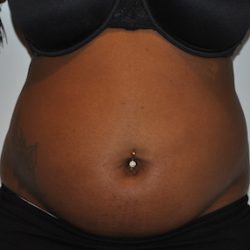 Liposuction Before & After Patient #2560