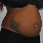 Liposuction Before & After Patient #2560